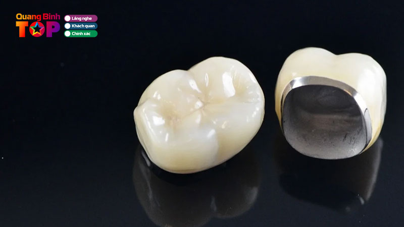 Can-xem-xet-ky-luong-truoc-khi-lua-chon-rang-su-kim-loai-phuc-hinh-rang-quangbinhtoplist