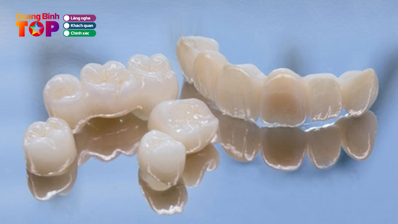 Rang-toan-su-yeu-cau-chi-phi-cao-va-co-ky-thuat-phuc-hinh-tot-quangbinhtoplist