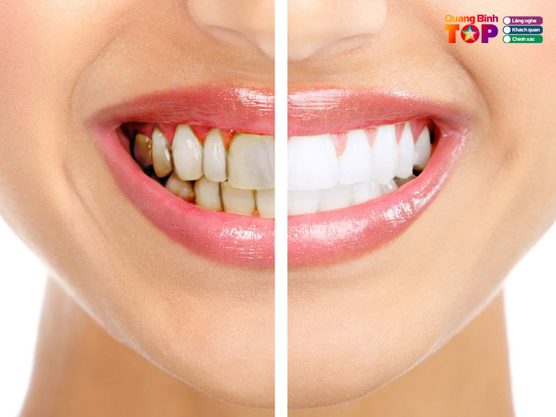 Mot-vai-kinh-nghiem-chon-dia-chi-tay-trang-rang-uy-tin-quangbinhtoplist