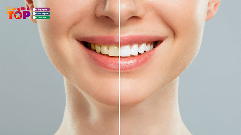 Top-7-dia-chi-tay-trang-rang-tai-quang-binh-sang-dep-an-toan-quangbinhtoplist