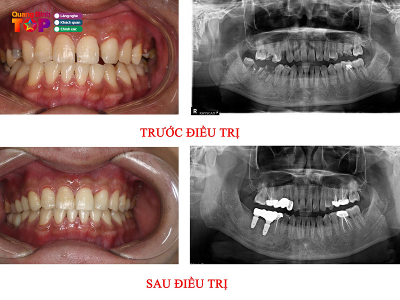 Nha-khoa-nhan-thao-quangbinhtoplist