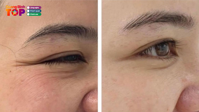 Top-10-dia-chi-xoa-nep-nhan-quang-binh-giup-da-cang-min-tu-nhien-quangbinhtoplist