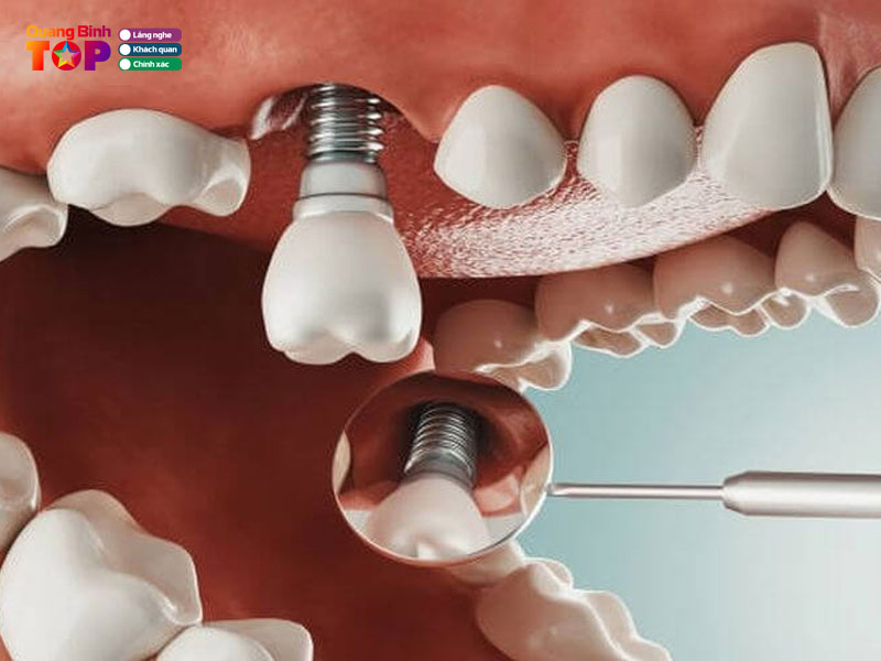 Kinh-nghiem-chon-dia-chi-trong-rang-implant-quang-binh-quangbinhtoplist