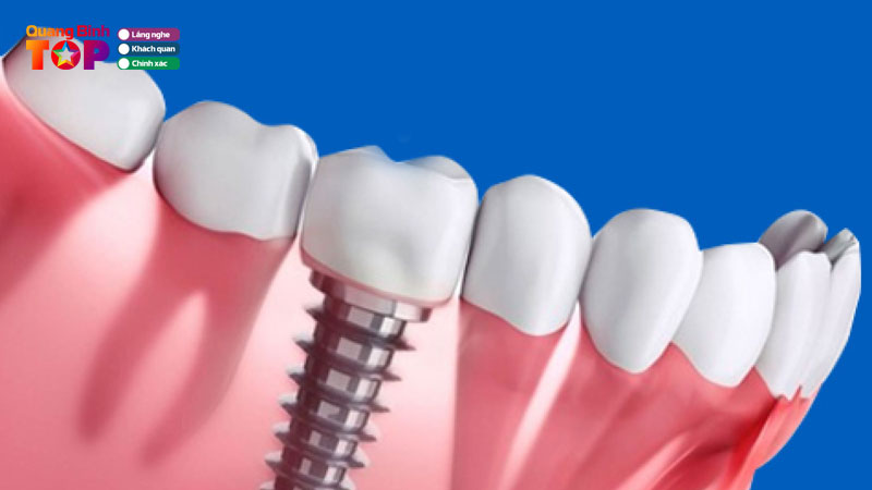 Top-11-dia-chi-trong-rang-implant-quang-binh-cong-nghe-hien-dai-quangbinhtoplist