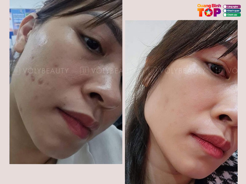 Vo-ly-beauty-spa-quangbinhtoplist